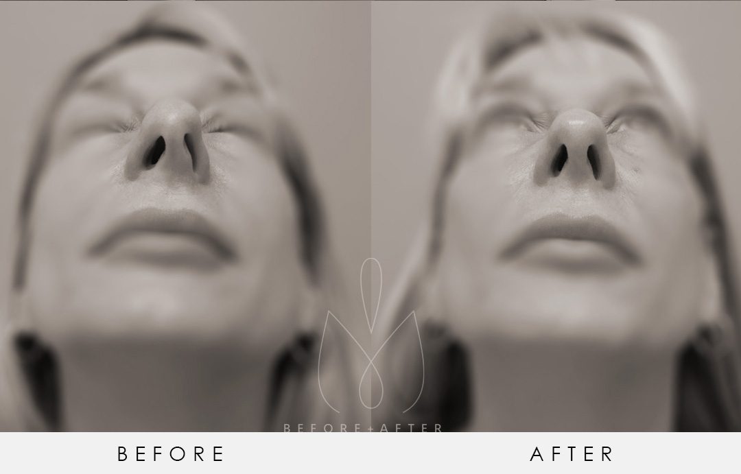 Dr-Earle2-34-Rhinoplasty-Pure-Plastic-Surgery-Miami-Before-After-e1591827342640