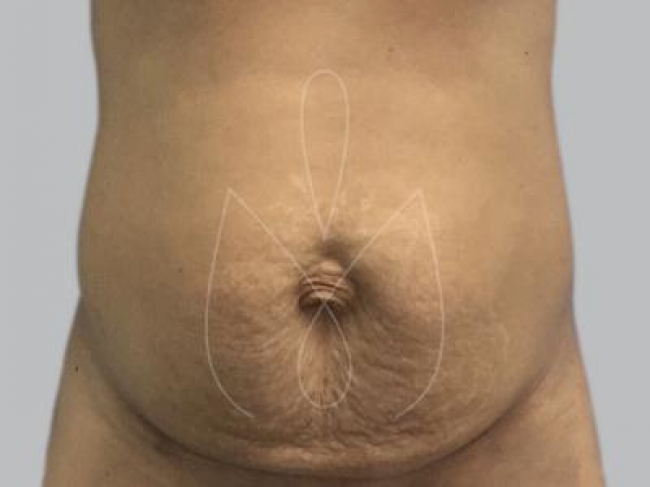 Abdominoplastia Miami