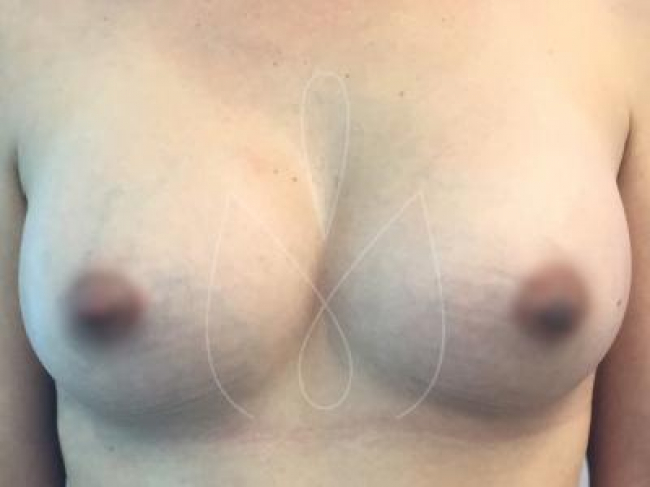 Breast Augmentation Miami
