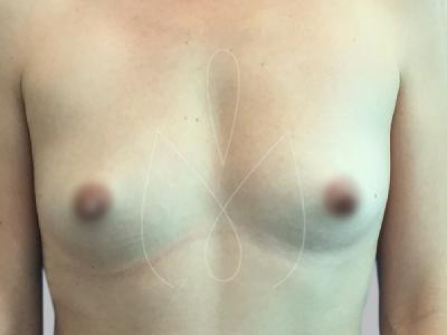 Breast Augmentation Miami