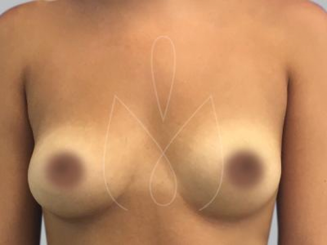 Aumento de senos Miami