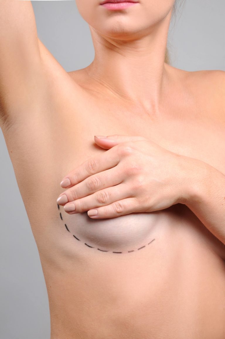 Breast Lift Miami